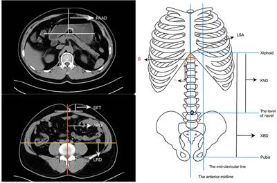 A Simple Predictive Index of the Abdominal Shape for Postoperative Complications After Laparoscopy-Assisted Distal Gastrectomy for Gastric Cancer